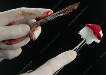 ^BSurgical instruments.^b Gloved hands holding a blood stained scalpel and gauze. Scalpels are instruments used to make surgical incisions. Gauze is an absorbent material used as a dressing or to mop-up blood during surgery.